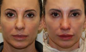 Nasal deformity correction